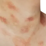 Skóra na szyi i dekolcie z czerwonymi, łuszczącymi się plamami, przypominającymi łupież Gilberta.