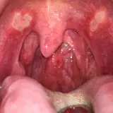 Gola arrossata con afte sul palato e sulle tonsille. Si notano lesioni biancastre e infiammazione.