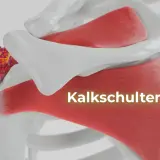 Kalkschulter: Ablagerungen im Schultergelenk. Was tun? Hier sehen Sie die Ursache von Schulterschmerzen.