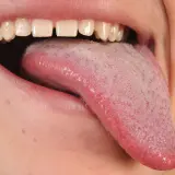 Boca abierta mostrando lengua rosada con pequeñas protuberancias rojas, quizás por eso salen granos en la lengua.