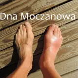 Dna moczanowa powoduje ból i obrzęk stawów, jak widać na opuchniętej stopie.