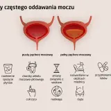 Ilustracja przedstawia przyczyny częstego oddawania moczu, w tym nadreaktywny pęcherz objawy: nadmierne picie, choroby układu moczowo-płciowego, wiek, naświetlanie, leki, cukrzyca, nadwaga, ciąża.