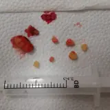 Na białym tle leżą grudki i kilka żółtawych kuleczek, przypominających moczany bezpostaciowe w moczu. Obok znajduje się strzykawka.