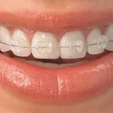 Sonrisa con brackets transparentes, mostrando dientes que necesitan brackets para alinearse y lucir perfectos.