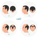 Escala de Norwood que muestra la progresión de la pérdida de cabello, desde una densidad capilar completa hasta la calvicie.