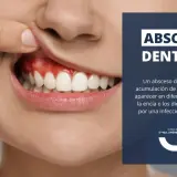 Primer plano de una boca mostrando encías rojas e inflamadas, indicativo de un absceso en la encía. Texto informativo sobre abscesos dentales.