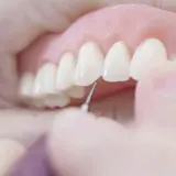 Dettaglio di una dentiera che viene posizionata, un passo importante per abituarsi alla dentiera e ritrovare un sorriso smagliante.