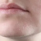 Gros plan sur des lèvres et un menton montrant une peau sèche et squameuse, signe potentiel d'une cause de peau sèche.