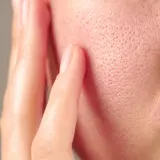 Gros plan sur la joue d'une personne, montrant les pores de la peau et un doigt effleurant délicatement la surface.