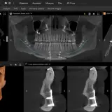 CBCT co to? Obraz przedstawia skany 3D szczęki i żuchwy z implantami, pokazujące szczegółową anatomię kości i zębów.