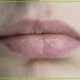 Suche usta, popękane i łuszczące się, mogą świadczyć o braku witaminy.