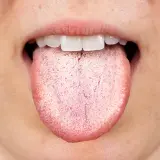 Lingua bianca e ruvida, possibile effetto collaterale di un antibiotico.