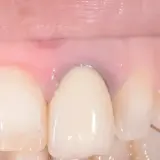 Dettaglio di denti con una corona e gengive rosa, con alcune aree che mostrano sfumature di gengive nere.