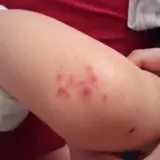 Lesioni cutanee rosse e pruriginose su un braccio di bambino, indicative di impetigine.