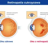 Porównanie zdrowego oka z naczyniami krwionośnymi siatkówki i oka z retinopatią cukrzycową, gdzie widoczne są mikrowylewy.