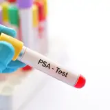 Rękawiczka trzyma probówkę z napisem "PSA - Test". To badanie psa, które pozwala ocenić jego stan zdrowia.