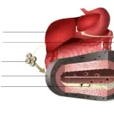 Jak obliczyć cholesterol resztkowy i zrozumieć jego znaczenie dla zdrowia