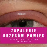 Oko z zaczerwienionym, opuchniętym brzegiem powieki, wskazujące na łojotokowe zapalenie powiek.