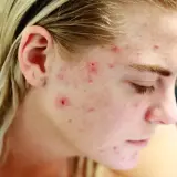 Skóra młodej osoby z widocznymi zmianami trądzikowymi, spowodowanymi przez bakterie Cutibacterium acnes.