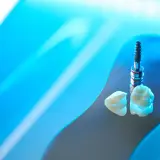 Impianti in zirconia e corone dentali, un futuro di sorrisi perfetti.