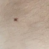 Kleszcz czy pieprzyk? Sprawdź, zanim spanikujesz! Ekspert radzi