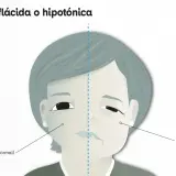 Ilustración comparativa de un rostro con parálisis facial. Un lado muestra un hemisferio sano, el otro un hemisferio con parálisis facial, con hipotonía.