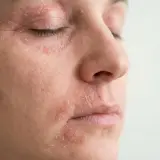 Skóra wokół oczu i ust jest zaczerwieniona i łuszcząca się, co wskazuje na atopowe zapalenie skóry na powiekach i wokół ust.