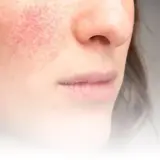 Närbild på en kvinna med rodnad på kinden, ett tecken på rosacea. Bilden visar hur man kan behandla rosacea.