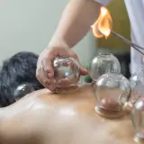 Terapeuta stosuje bańki na plecy pacjenta, podgrzewając je ogniem.