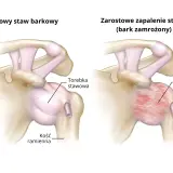 Porównanie zdrowego stawu barkowego z zapaleniem mięśnia barkowego (bark zamrożony), gdzie torebka stawowa jest pogrubiała i usztywniona.