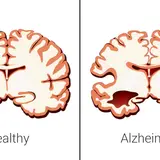 Choroba Alzheimera: neurologiczna czy psychiczna? Rozwiewam wątpliwości