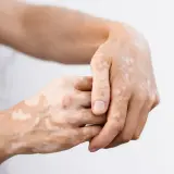 Dłonie z plamami bielactwa nabytego od stresu. Jasne przebarwienia na skórze tworzą nieregularne wzory.