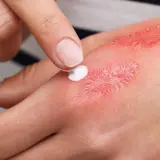 Application de crème sur une brûlure pour favoriser l'étape cicatrisation brûlure. La peau est rouge et irritée.