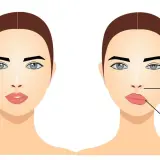 Comparación de un rostro normal con uno afectado por parálisis de Bell, mostrando caída del ojo, pérdida del pliegue nasolabial y caída de la comisura de la boca.