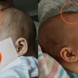 Dwa ujęcia główki niemowlaka, pokazujące jak zarasta ciemiączko. Na obu zdjęciach widoczne są pomarańczowe kółka zaznaczające obszar ciemiączka.