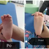 Dwa zdjęcia stopy dziecka: po lewej stopa sierpowata, po prawej ta sama stopa po terapii.