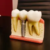 Model szczęki z zębami, gdzie jeden z nich zastąpiono przez mini implant ortodontyczny.