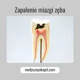 Przekrój zęba ukazujący próchnicę sięgającą do miazgi zęba, która jest zaczerwieniona i zaogniona.
