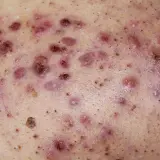 Piel con múltiples pápulas, pústulas y nódulos inflamados, característicos del acne conglobata.