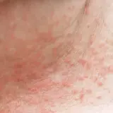 Hautirritation mit roten Pusteln, die beim Schwitzen juckt.