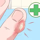 Gros plan d'un doigt enflammé avec une corne sur les mains, entouré d'un symbole médical vert.
