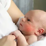 Malutkie dziecko z zaczerwienionymi policzkami, objawami azs u niemowlaka, tulone przez bliską osobę.