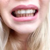 Uśmiech z Invisalign. Czy warto? Opinie pacjentów są różne, ale efekt prostych zębów jest widoczny.