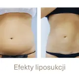 Po liposukcji tłuszcz wraca? Nie! Jak utrzymać nową sylwetkę