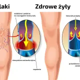 Porównanie nóg z żylakami i zdrowych żył. Pokazuje osłabione ściany żył i niewydolne zastawki, które powodują żylaki.