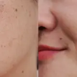 Comparación de piel: antes con manchas y poros visibles, después con piel lisa y uniforme.