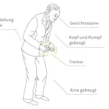 Diagnostik Parkinson Krankheit: So erkennen Sie die Symptome rechtzeitig