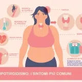 Ipotiridismo: sintomi come perdita capelli, stanchezza, aumento peso e ansia. La tiroide ipotiroidea causa questi disturbi.