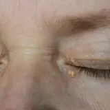 Párpados con xantelasma, depósitos amarillentos de colesterol cerca de los ojos.