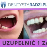 Ubytek w uzębieniu, widoczna budowa zęba jedynki po utracie.
